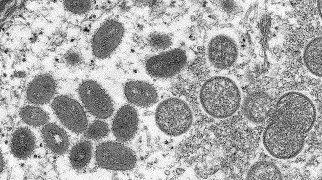 意大利和瑞典分別報告首例猴痘病例