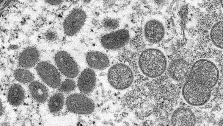 俄研發猴痘病毒檢測盒 已完成實驗室測試