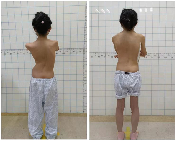 圖3:患者術前術後外形圖。.jpg