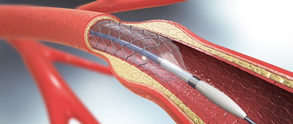 700元的「冠脈支架」在廣東明年可用