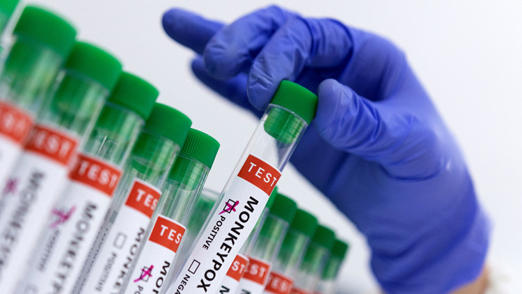 英國猴痘病確診逾千 短期增勢难挽