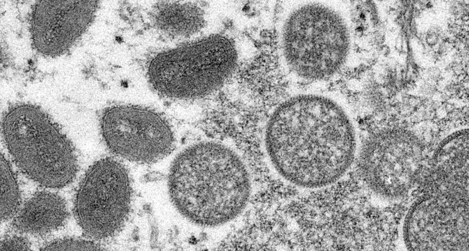 法國猴痘病例確診超1700例 巴黎將開放大型疫苗接種中心