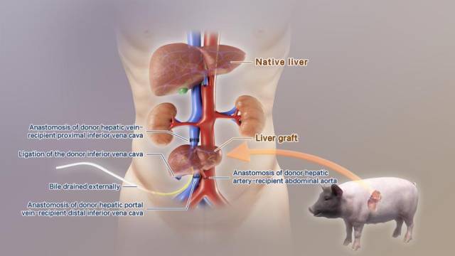 全球首例！中國團隊成功將基因編輯豬肝臟移植人體